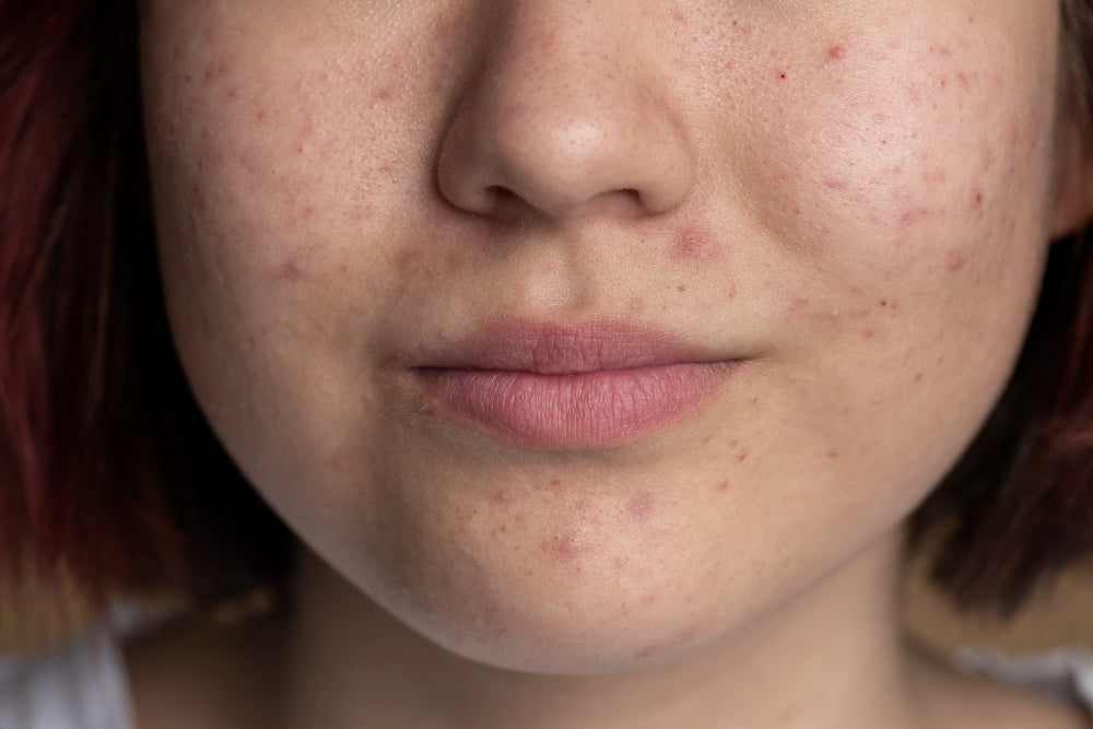 Can Hyaluronic Acid Trigger Acne?