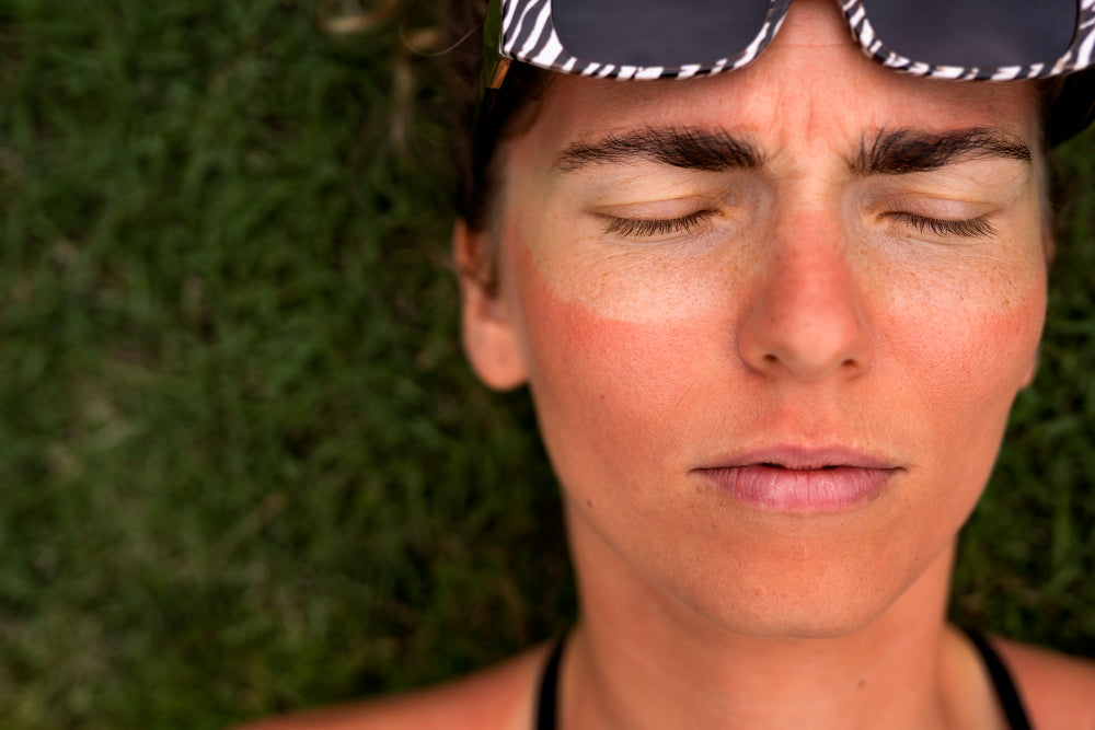 Is Hyaluronic Acid Good for Sunburn?